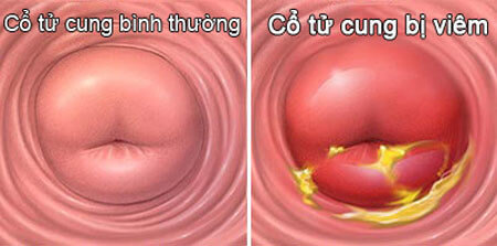 Viêm cổ tử cung 